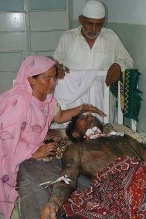 Un familiar cuida del hombre quemado con ácido en Paquistán. (Agencias)