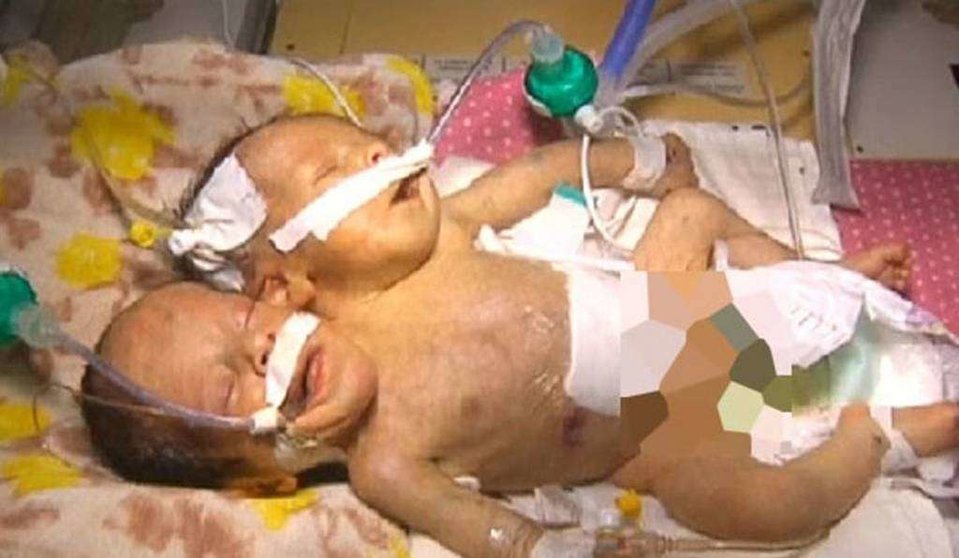 Los bebés siameses nacidos en Yemen.