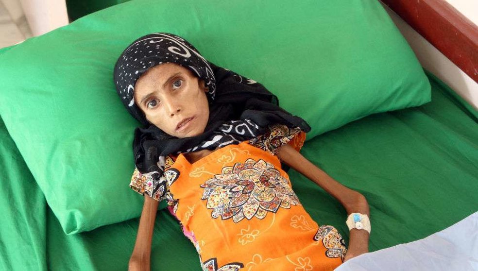 La niña yemení Fátima: 12 años y 10 kilos.